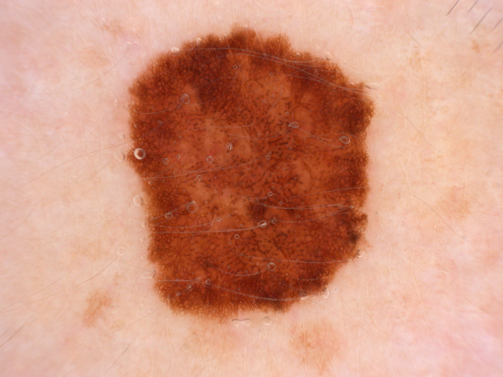 Melanoma lesion sample