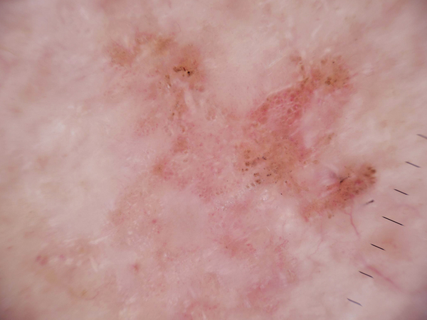 Squamous cell carcinoma lesion sample