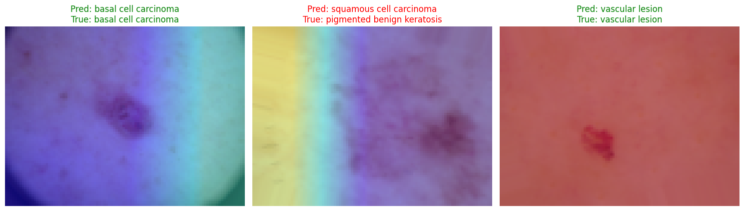 Grad-CAM heatmaps on skin lesion images